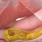 התרופה המהפכנית שהולכת לנצח את סרטן הלבלב מגייסת משקיעים ישראליים!