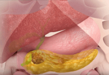 התרופה המהפכנית שהולכת לנצח את סרטן הלבלב מגייסת משקיעים ישראליים!