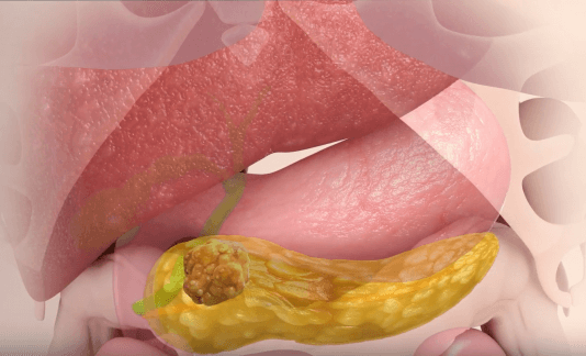 התרופה המהפכנית שהולכת לנצח את סרטן הלבלב מגייסת משקיעים ישראליים!