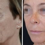 הגיל הוא רק מספר – זה הזמן להעלים את הקמטים!