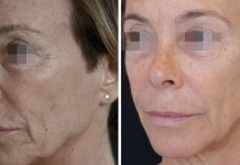 הגיל הוא רק מספר – זה הזמן להעלים את הקמטים!