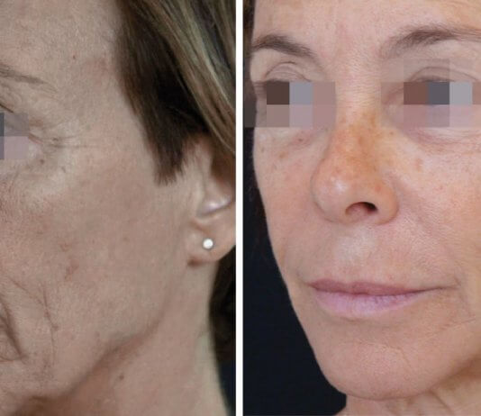 הגיל הוא רק מספר – זה הזמן להעלים את הקמטים!